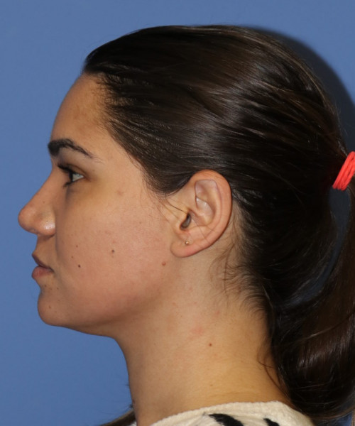 Rhinoplasty 5564 – Click HERE for more views after photo. Individual results may vary.