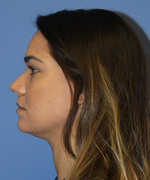 Rhinoplasty 5564 – Click HERE for more views before photo. Individual results may vary.