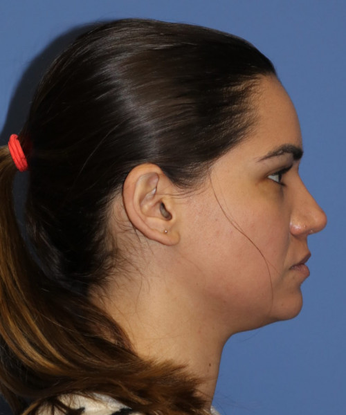 Rhinoplasty 5564 – Click HERE for more views after photo. Individual results may vary.