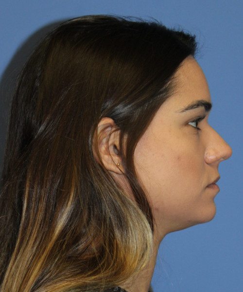 Rhinoplasty 5564 – Click HERE for more views before photo. Individual results may vary.