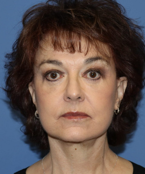 Facelift, Browlift, Blepharoplasty, Lip Augmentation, Facial Fat Grafting #5612 – Click HERE for more views after photo. Individual results may vary.