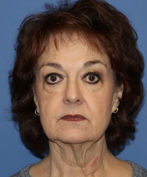 Facelift, Browlift, Blepharoplasty, Lip Augmentation, Facial Fat Grafting #5612 – Click HERE for more views before photo. Individual results may vary.