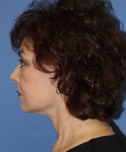 Facelift, Browlift, Blepharoplasty, Lip Augmentation, Facial Fat Grafting #5612 – Click HERE for more views after photo. Individual results may vary.