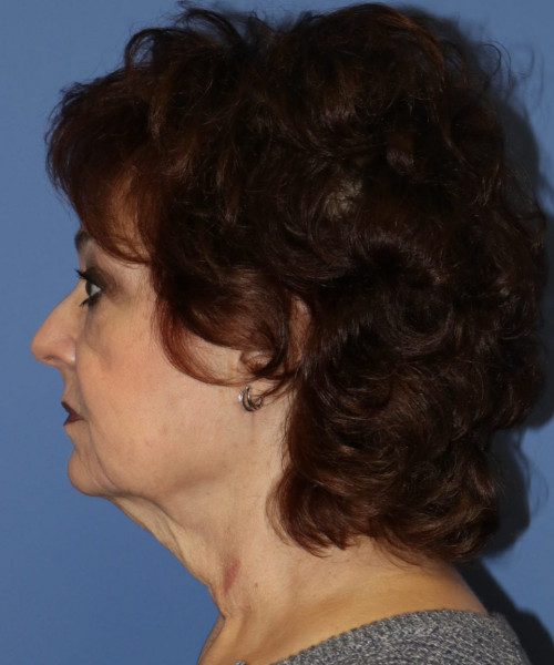 Facelift, Browlift, Blepharoplasty, Lip Augmentation, Facial Fat Grafting #5612 – Click HERE for more views before photo. Individual results may vary.