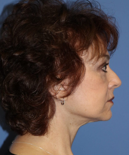 Facelift, Browlift, Blepharoplasty, Lip Augmentation, Facial Fat Grafting #5612 – Click HERE for more views after photo. Individual results may vary.