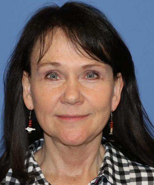 Facelift, Browlift, Blepharoplasty, SMAS Lip Augmentation #5632 – Click HERE for more views after photo. Individual results may vary.