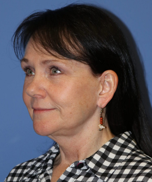 Facelift, Browlift, Blepharoplasty, SMAS Lip Augmentation #5632 – Click HERE for more views after photo. Individual results may vary.