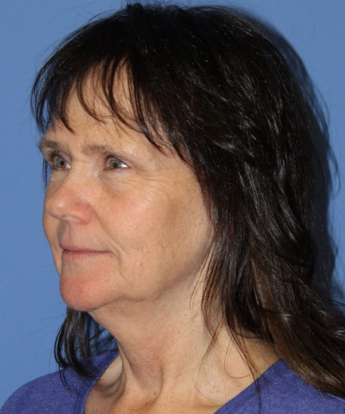 Facelift, Browlift, Blepharoplasty, SMAS Lip Augmentation #5632 – Click HERE for more views before photo. Individual results may vary.