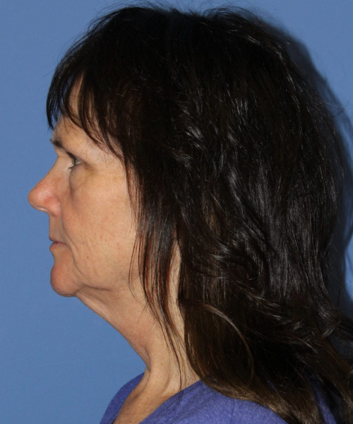 Facelift, Browlift, Blepharoplasty, SMAS Lip Augmentation #5632 – Click HERE for more views before photo. Individual results may vary.