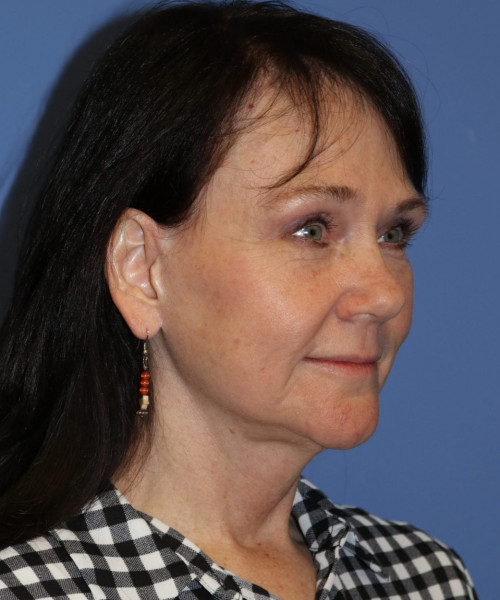 Facelift, Browlift, Blepharoplasty, SMAS Lip Augmentation #5632 – Click HERE for more views after photo. Individual results may vary.