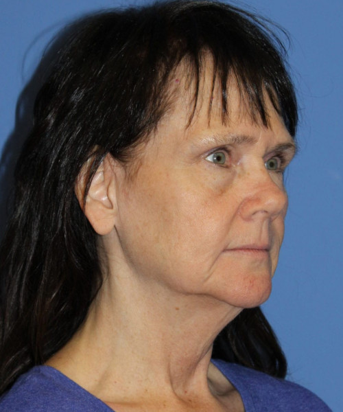 Facelift, Browlift, Blepharoplasty, SMAS Lip Augmentation #5632 – Click HERE for more views before photo. Individual results may vary.