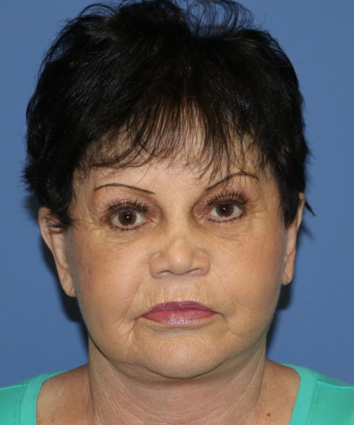 Facelift, Browlift, SMAS Lip Augmentation #5643 – Click HERE for more views after photo. Individual results may vary.