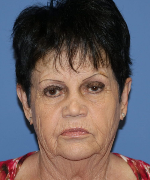 Facelift, Browlift, SMAS Lip Augmentation #5643 – Click HERE for more views before photo. Individual results may vary.