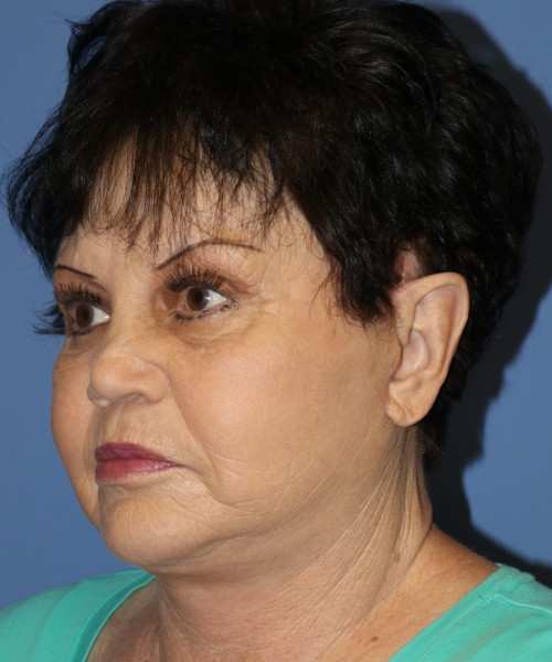 Facelift, Browlift, SMAS Lip Augmentation #5643 – Click HERE for more views after photo. Individual results may vary.