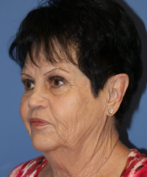 Facelift, Browlift, SMAS Lip Augmentation #5643 – Click HERE for more views before photo. Individual results may vary.
