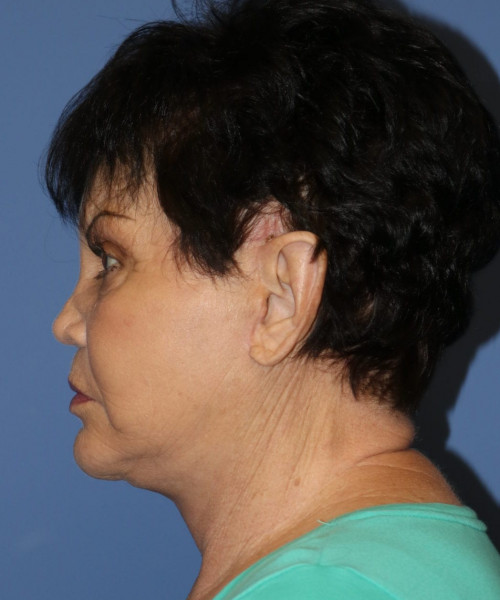 Facelift, Browlift, SMAS Lip Augmentation #5643 – Click HERE for more views after photo. Individual results may vary.