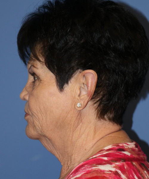 Facelift, Browlift, SMAS Lip Augmentation #5643 – Click HERE for more views before photo. Individual results may vary.