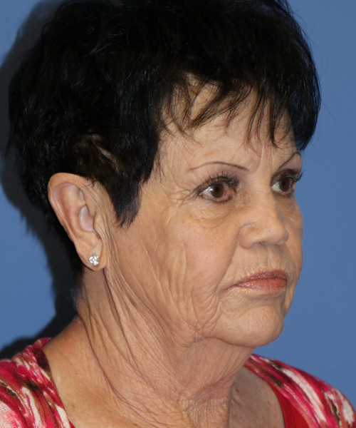 Facelift, Browlift, SMAS Lip Augmentation #5643 – Click HERE for more views before photo. Individual results may vary.