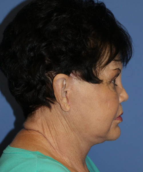 Facelift, Browlift, SMAS Lip Augmentation #5643 – Click HERE for more views after photo. Individual results may vary.