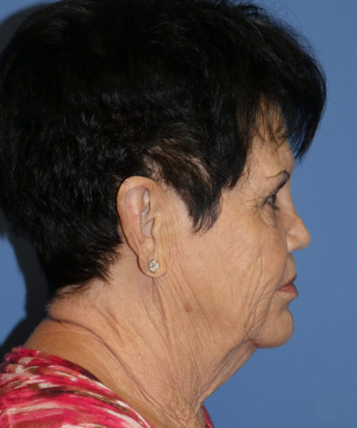 Facelift, Browlift, SMAS Lip Augmentation #5643 – Click HERE for more views before photo. Individual results may vary.