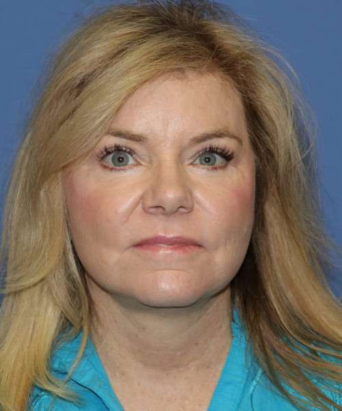 Facelift, Browlift, Blepharoplasty, Lip Augmentation, Laser Skin Resurfacing, Buccal Fat Pad Removal #5654 – Click HERE for more views after photo. Individual results may vary.
