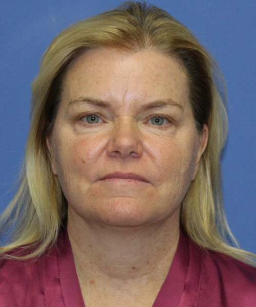 Facelift, Browlift, Blepharoplasty, Lip Augmentation, Laser Skin Resurfacing, Buccal Fat Pad Removal #5654 – Click HERE for more views before photo. Individual results may vary.