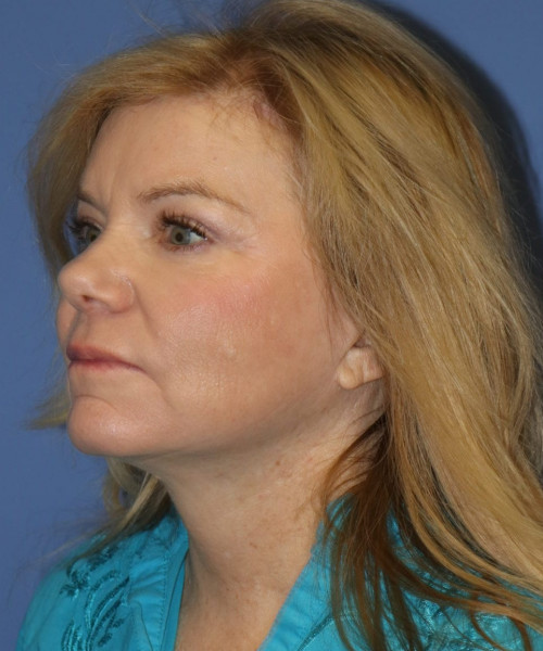 Facelift, Browlift, Blepharoplasty, Lip Augmentation, Laser Skin Resurfacing, Buccal Fat Pad Removal #5654 – Click HERE for more views after photo. Individual results may vary.
