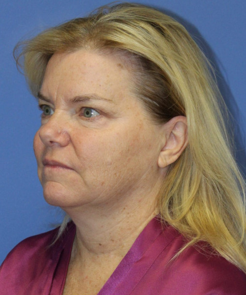 Facelift, Browlift, Blepharoplasty, Lip Augmentation, Laser Skin Resurfacing, Buccal Fat Pad Removal #5654 – Click HERE for more views before photo. Individual results may vary.