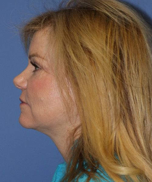 Facelift, Browlift, Blepharoplasty, Lip Augmentation, Laser Skin Resurfacing, Buccal Fat Pad Removal #5654 – Click HERE for more views after photo. Individual results may vary.