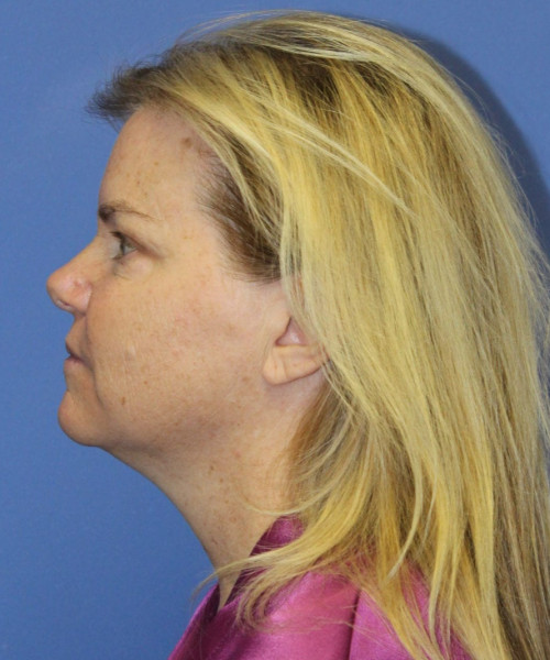 Facelift, Browlift, Blepharoplasty, Lip Augmentation, Laser Skin Resurfacing, Buccal Fat Pad Removal #5654 – Click HERE for more views before photo. Individual results may vary.