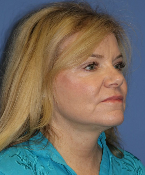 Facelift, Browlift, Blepharoplasty, Lip Augmentation, Laser Skin Resurfacing, Buccal Fat Pad Removal #5654 – Click HERE for more views after photo. Individual results may vary.