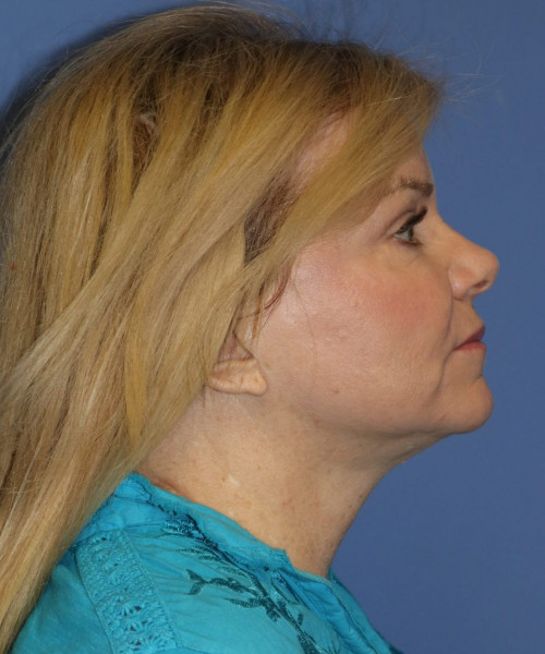 Facelift, Browlift, Blepharoplasty, Lip Augmentation, Laser Skin Resurfacing, Buccal Fat Pad Removal #5654 – Click HERE for more views after photo. Individual results may vary.