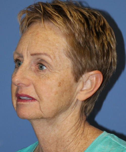 Facelift, Browlift, Blepharoplasty #5665 – Click HERE for more views before photo. Individual results may vary.