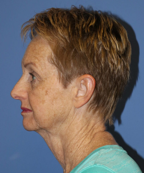 Facelift, Browlift, Blepharoplasty #5665 – Click HERE for more views before photo. Individual results may vary.