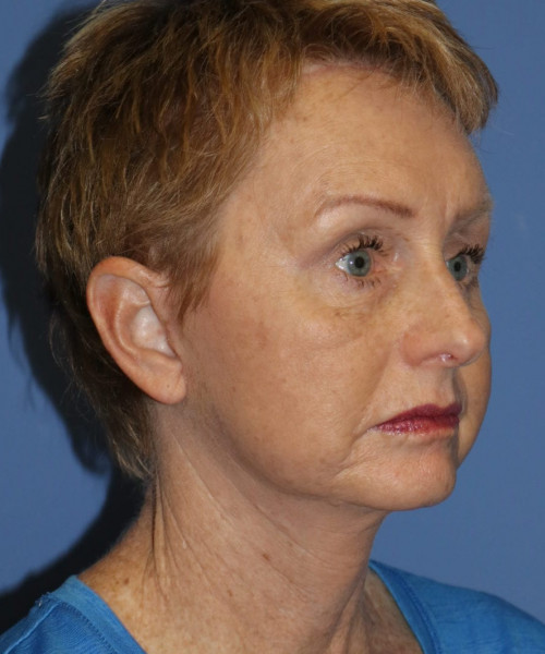Facelift, Browlift, Blepharoplasty #5665 – Click HERE for more views after photo. Individual results may vary.