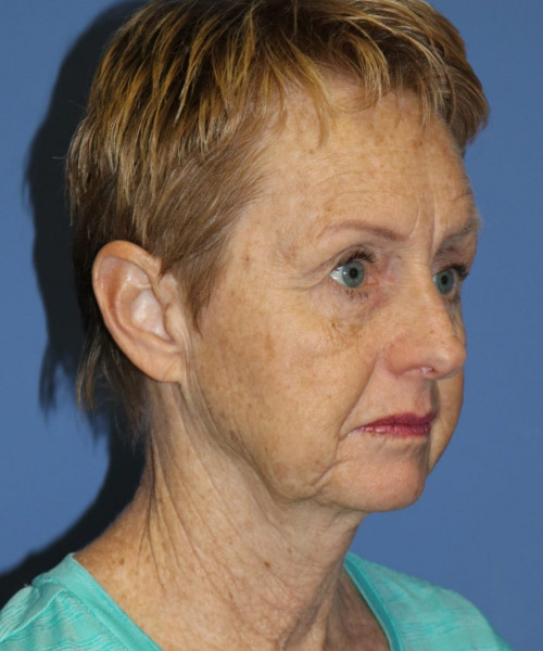 Facelift, Browlift, Blepharoplasty #5665 – Click HERE for more views before photo. Individual results may vary.