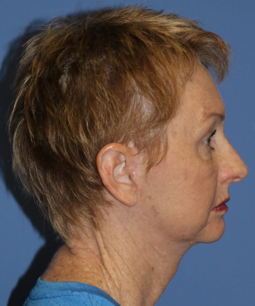 Facelift, Browlift, Blepharoplasty #5665 – Click HERE for more views after photo. Individual results may vary.