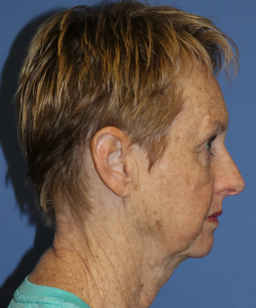 Facelift, Browlift, Blepharoplasty #5665 – Click HERE for more views before photo. Individual results may vary.