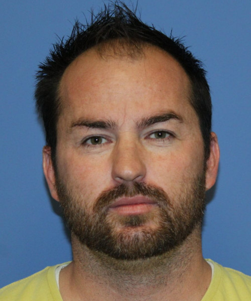 Large Hair Transplant #5718 – click HERE for more views before photo. Individual results may vary.