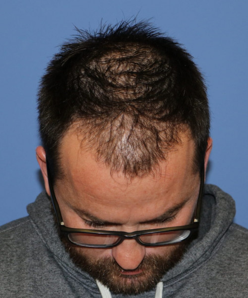 Large Hair Transplant #5718 – click HERE for more views after photo. Individual results may vary.