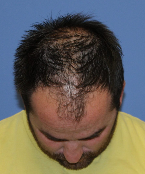 Large Hair Transplant #5718 – click HERE for more views before photo. Individual results may vary.