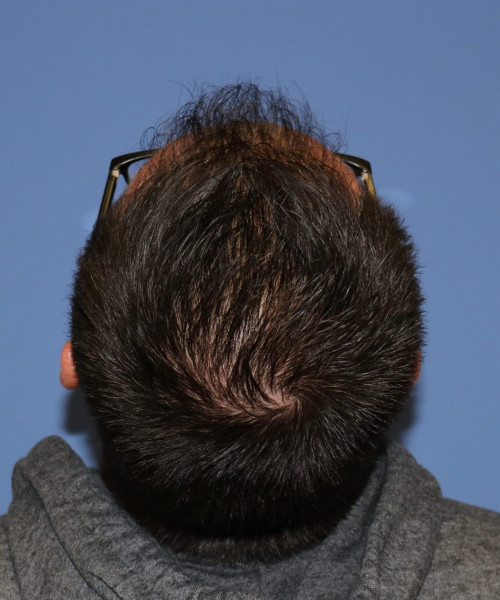 Large Hair Transplant #5718 – click HERE for more views after photo. Individual results may vary.