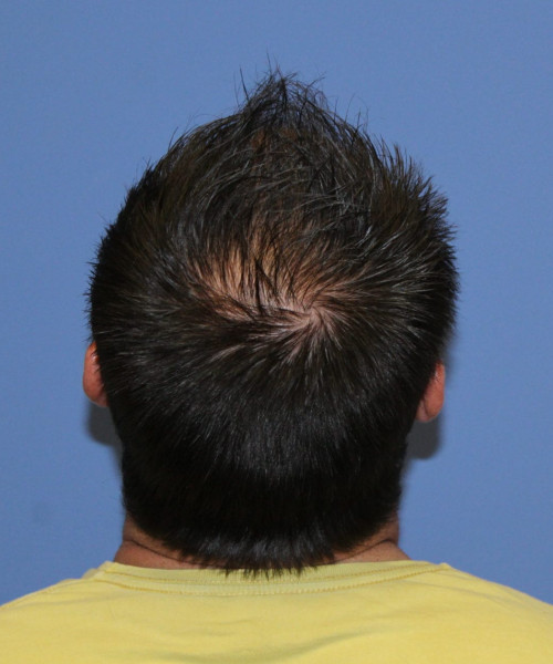 Large Hair Transplant #5718 – click HERE for more views before photo. Individual results may vary.