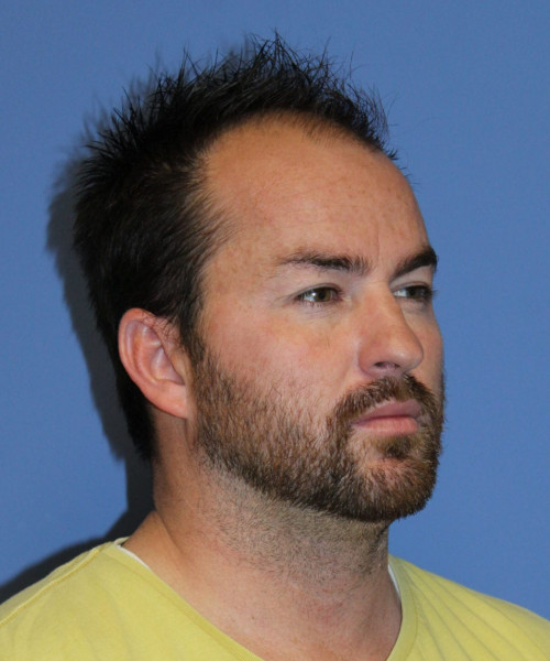 Large Hair Transplant #5718 – click HERE for more views before photo. Individual results may vary.