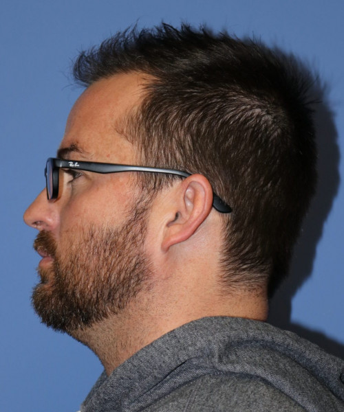 Large Hair Transplant #5718 – click HERE for more views after photo. Individual results may vary.