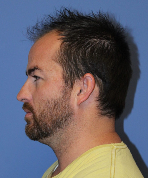 Large Hair Transplant #5718 – click HERE for more views before photo. Individual results may vary.