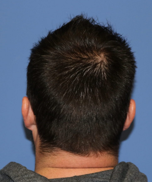 Large Hair Transplant #5718 – click HERE for more views after photo. Individual results may vary.