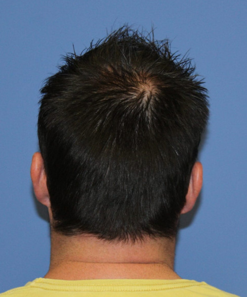 Large Hair Transplant #5718 – click HERE for more views before photo. Individual results may vary.