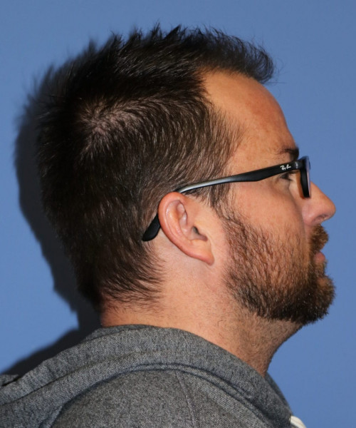 Large Hair Transplant #5718 – click HERE for more views after photo. Individual results may vary.