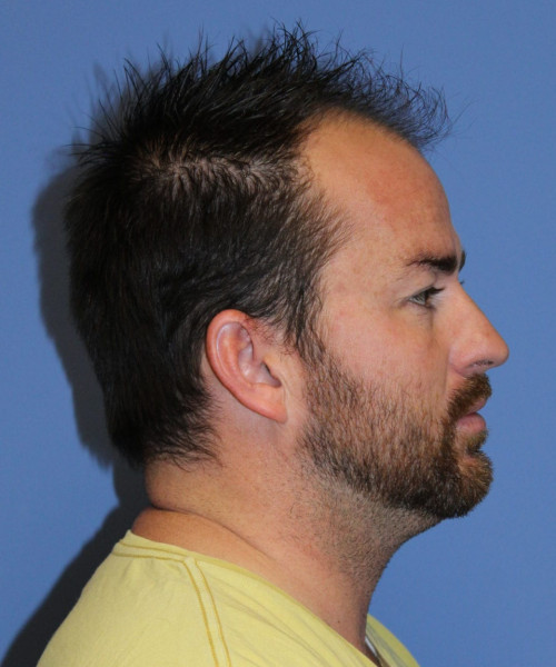 Large Hair Transplant #5718 – click HERE for more views before photo. Individual results may vary.